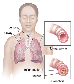 lung cancer.jpg